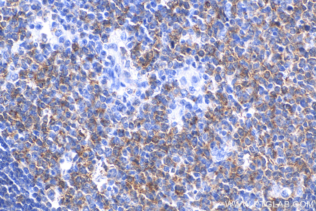 IHC staining of human tonsillitis using 82677-1-RR (same clone as 82677-1-PBS)