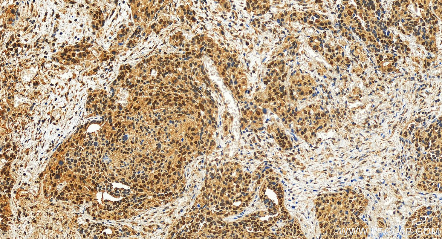 IHC staining of human ovary cancer using 10828-1-AP