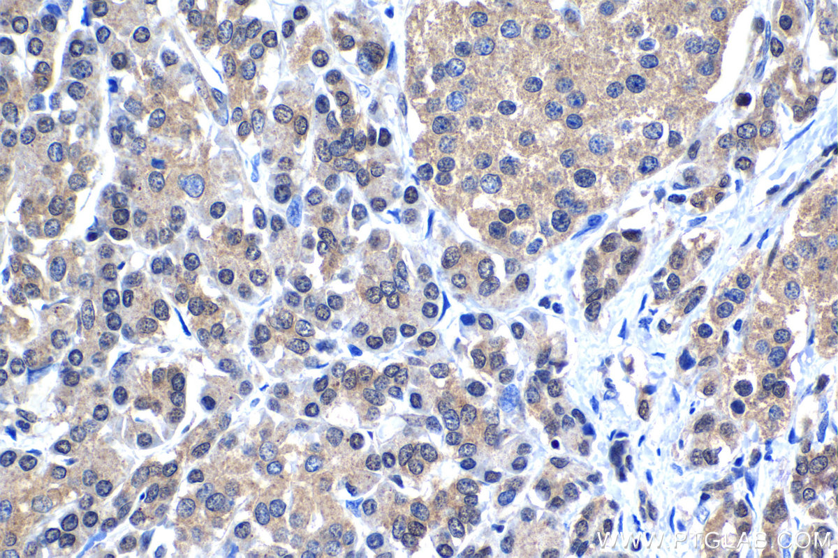 IHC staining of human pancreas cancer using 12022-1-AP