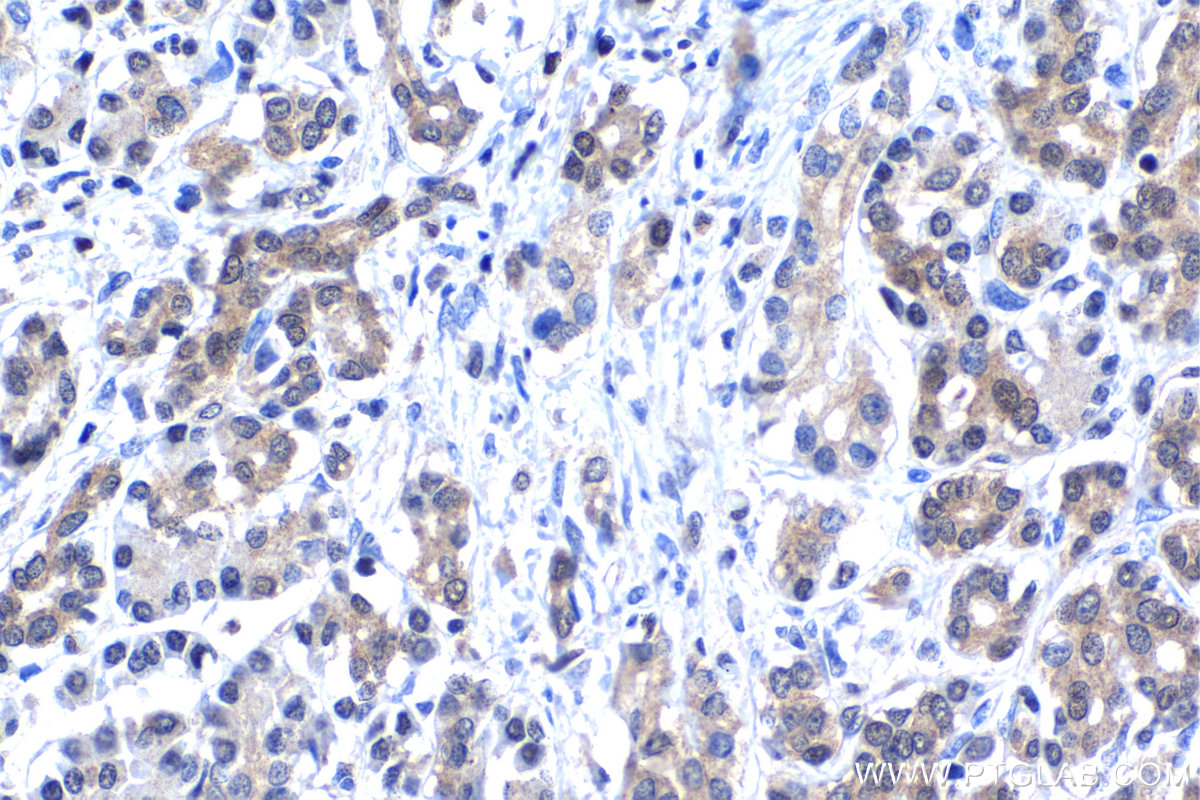 IHC staining of human pancreas cancer using 12022-1-AP