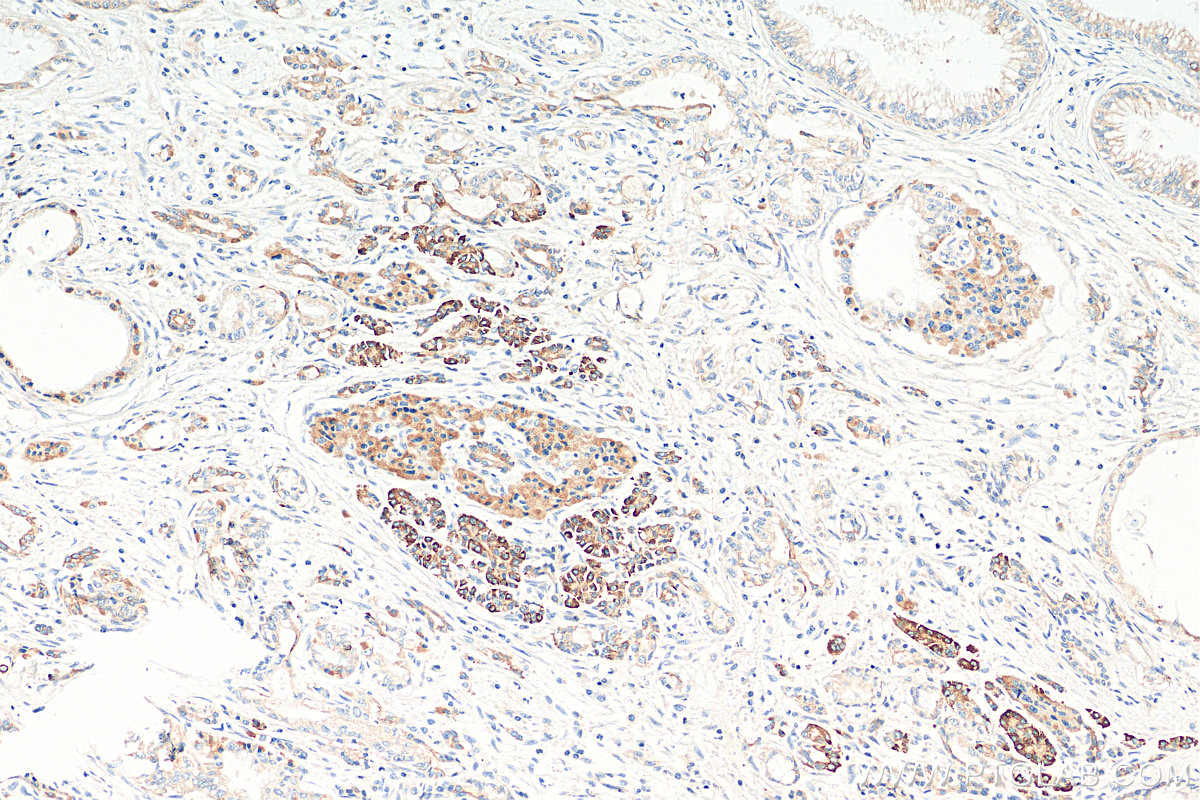 IHC staining of human pancreas cancer using 12763-1-AP