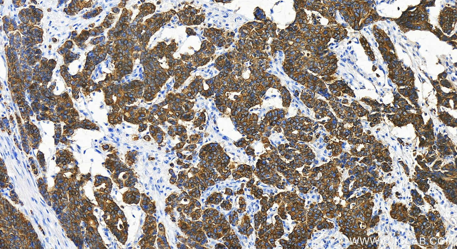 IHC staining of human stomach cancer using 20716-1-AP