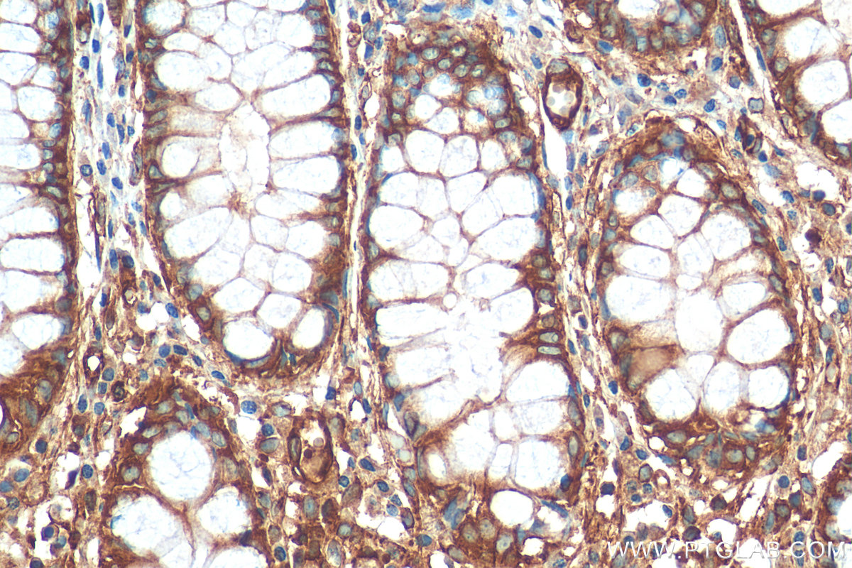 IHC staining of human colon using 68142-1-Ig (same clone as 68142-1-PBS)