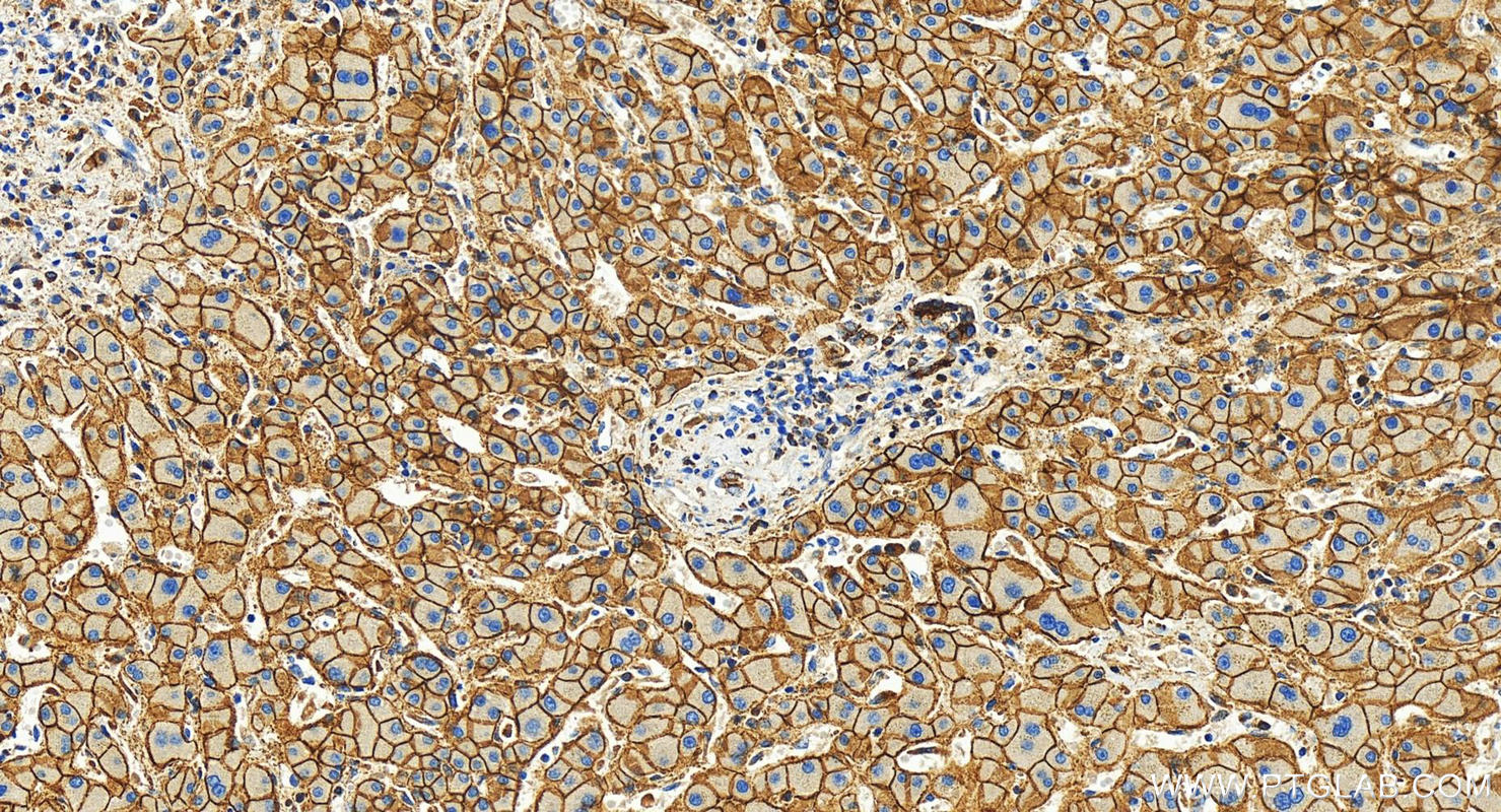 IHC staining of human intrahepatic cholangiocarcinoma using 82968-1-RR (same clone as 82968-1-PBS)