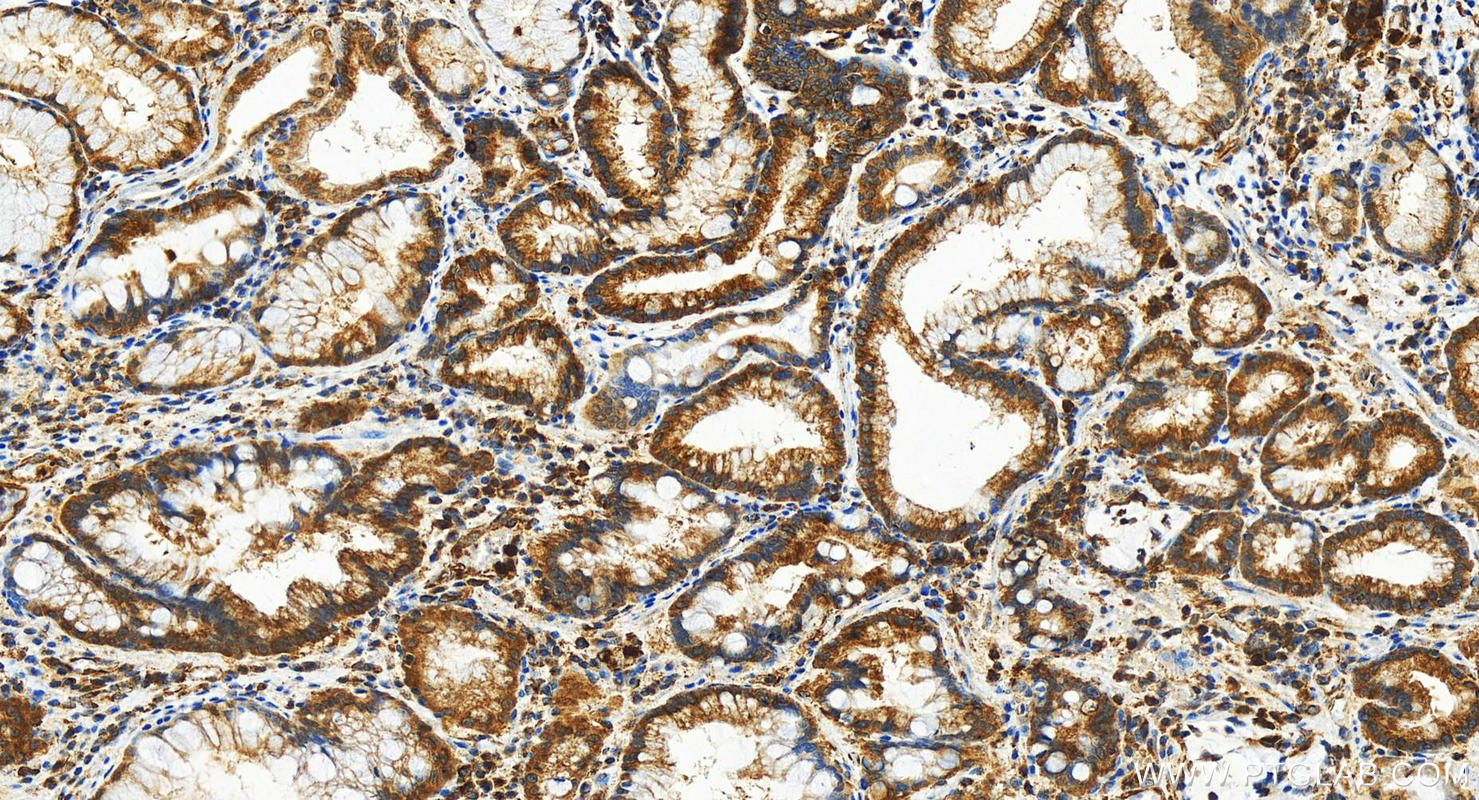 IHC staining of human stomach cancer using 29290-1-AP