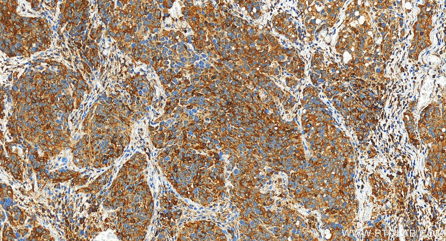 IHC staining of human ovary cancer using 29290-1-AP