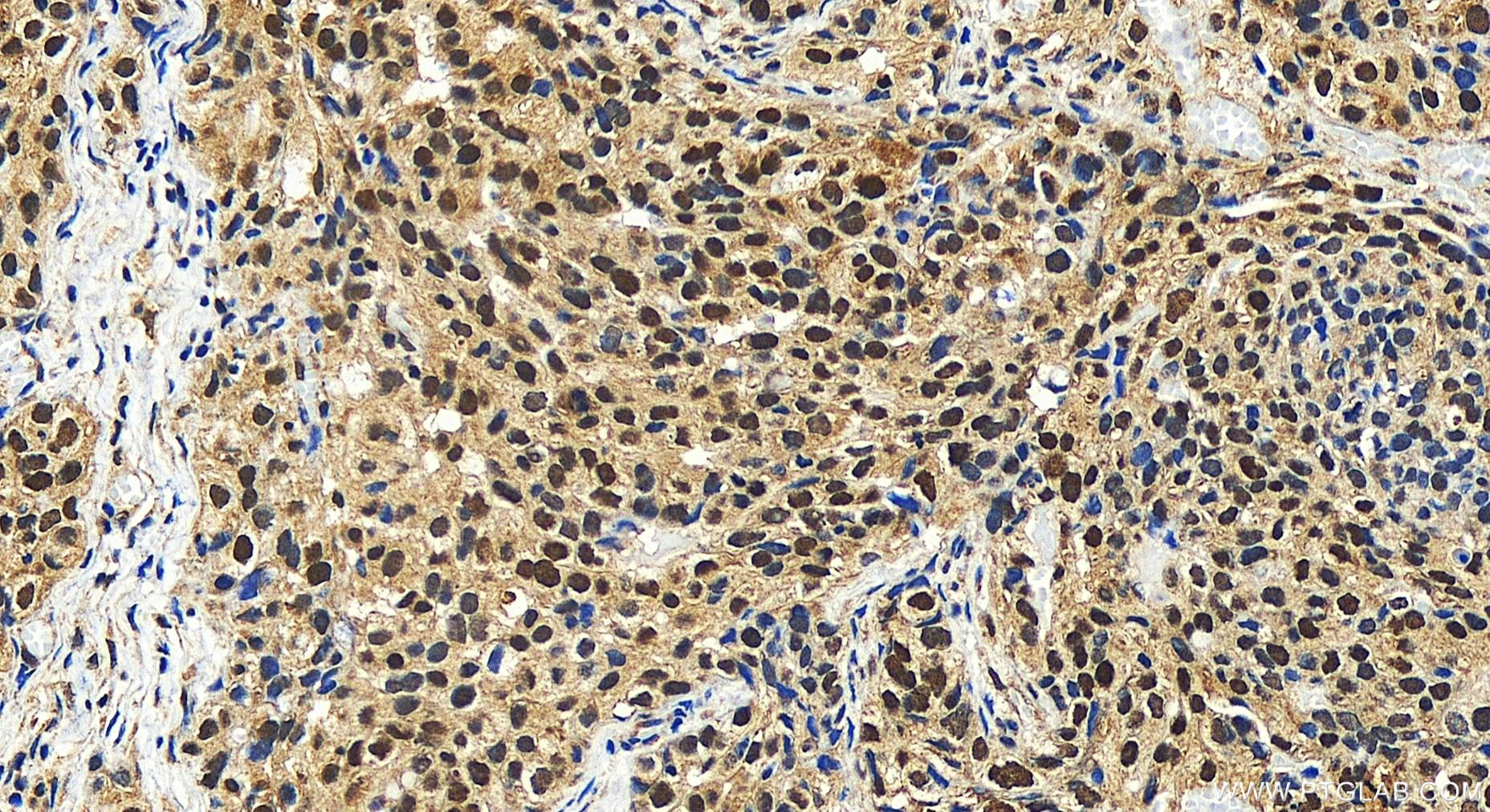 IHC staining of human ovary cancer using 27764-1-AP