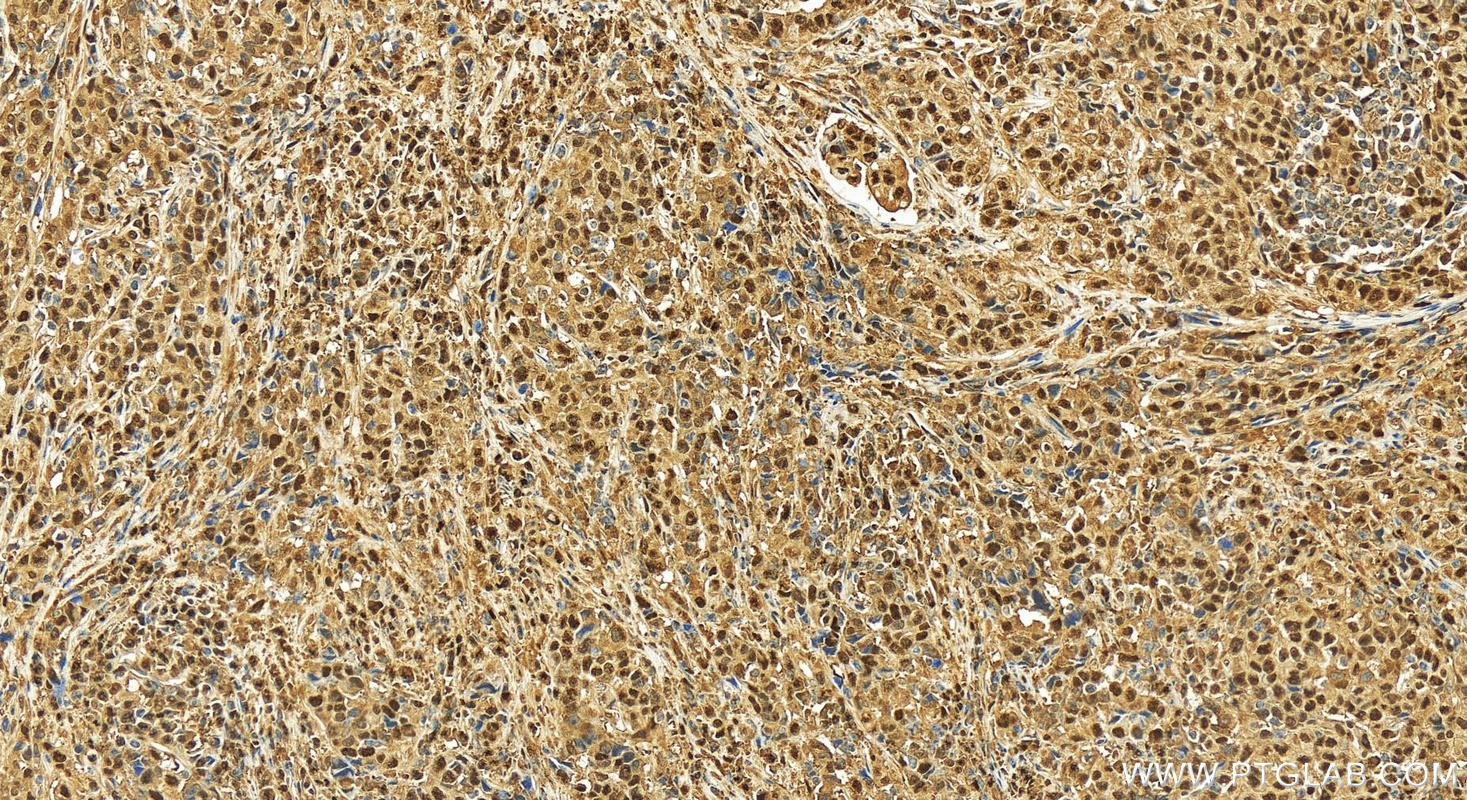 IHC staining of human stomach cancer using 15163-1-AP