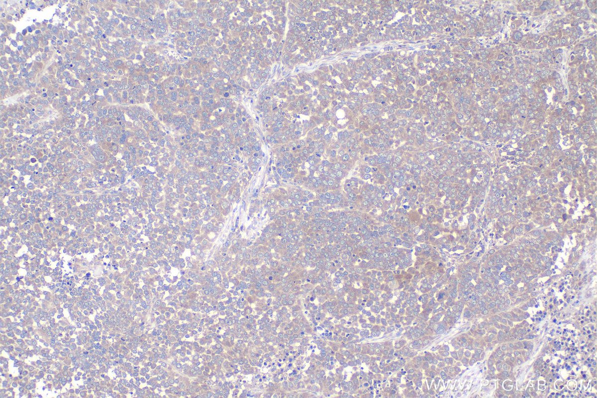 IHC staining of human ovary tumor using 15604-1-AP