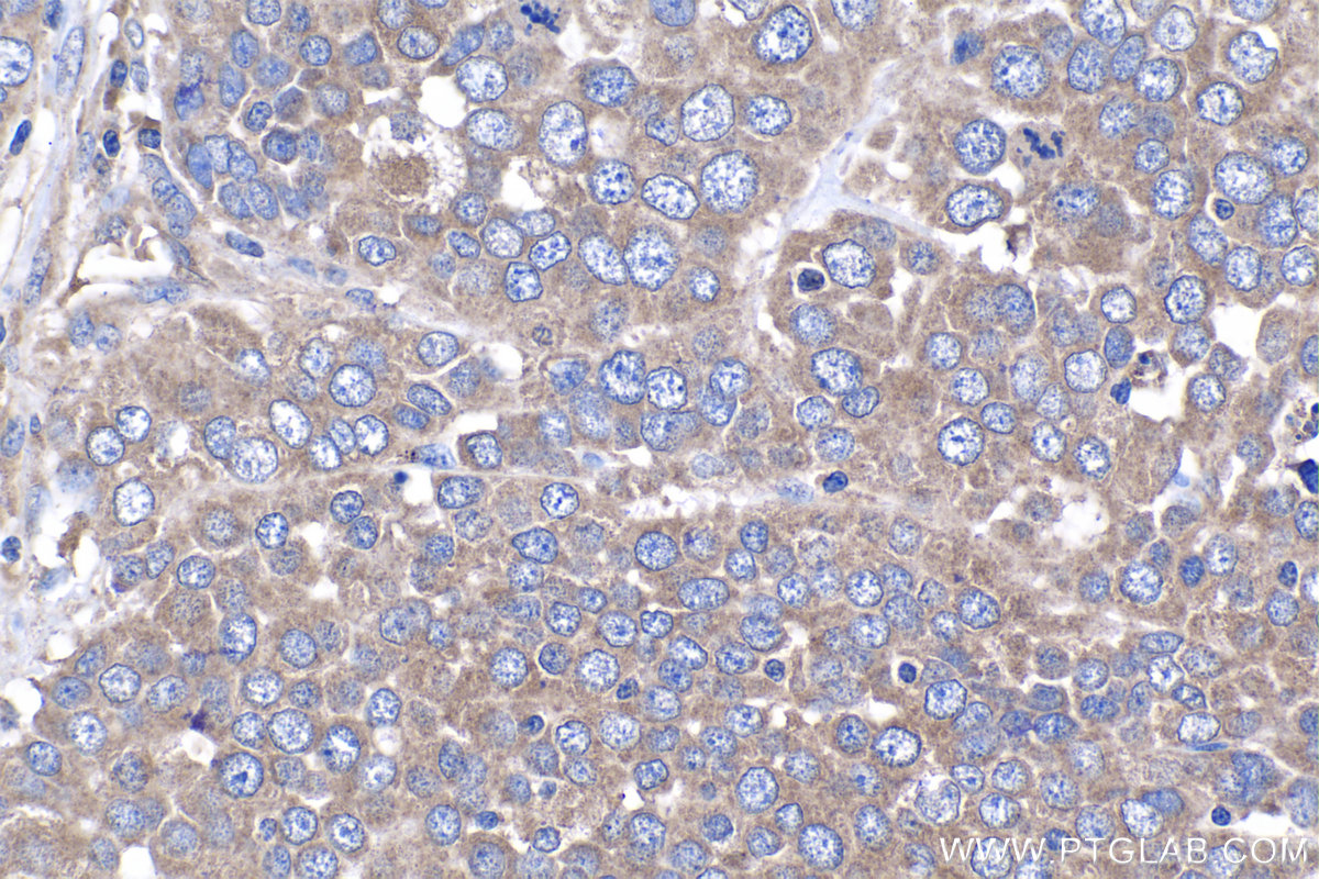 IHC staining of human ovary tumor using 15604-1-AP