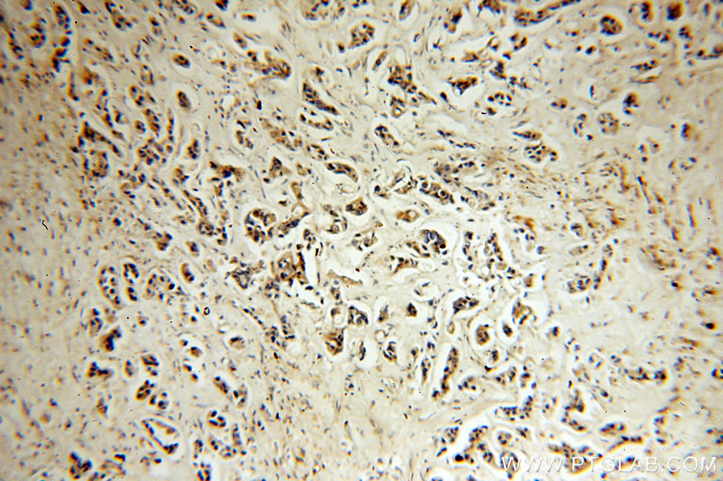 IHC staining of human breast cancer using 14394-1-AP