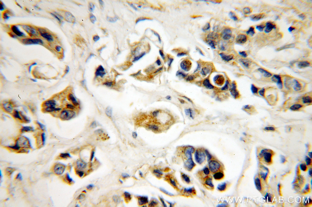 IHC staining of human breast cancer using 14394-1-AP