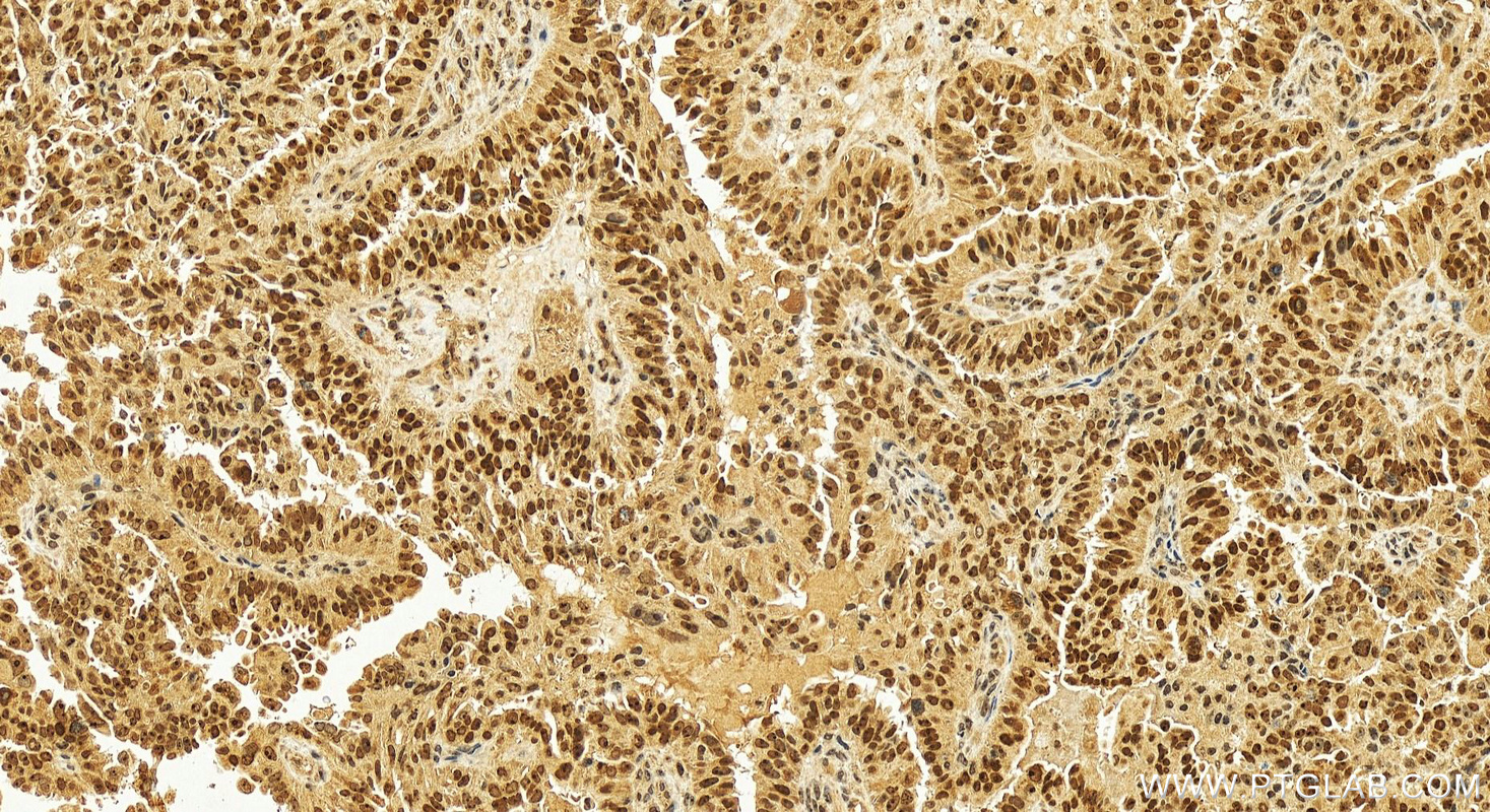 IHC staining of human ovary cancer using 13365-1-AP