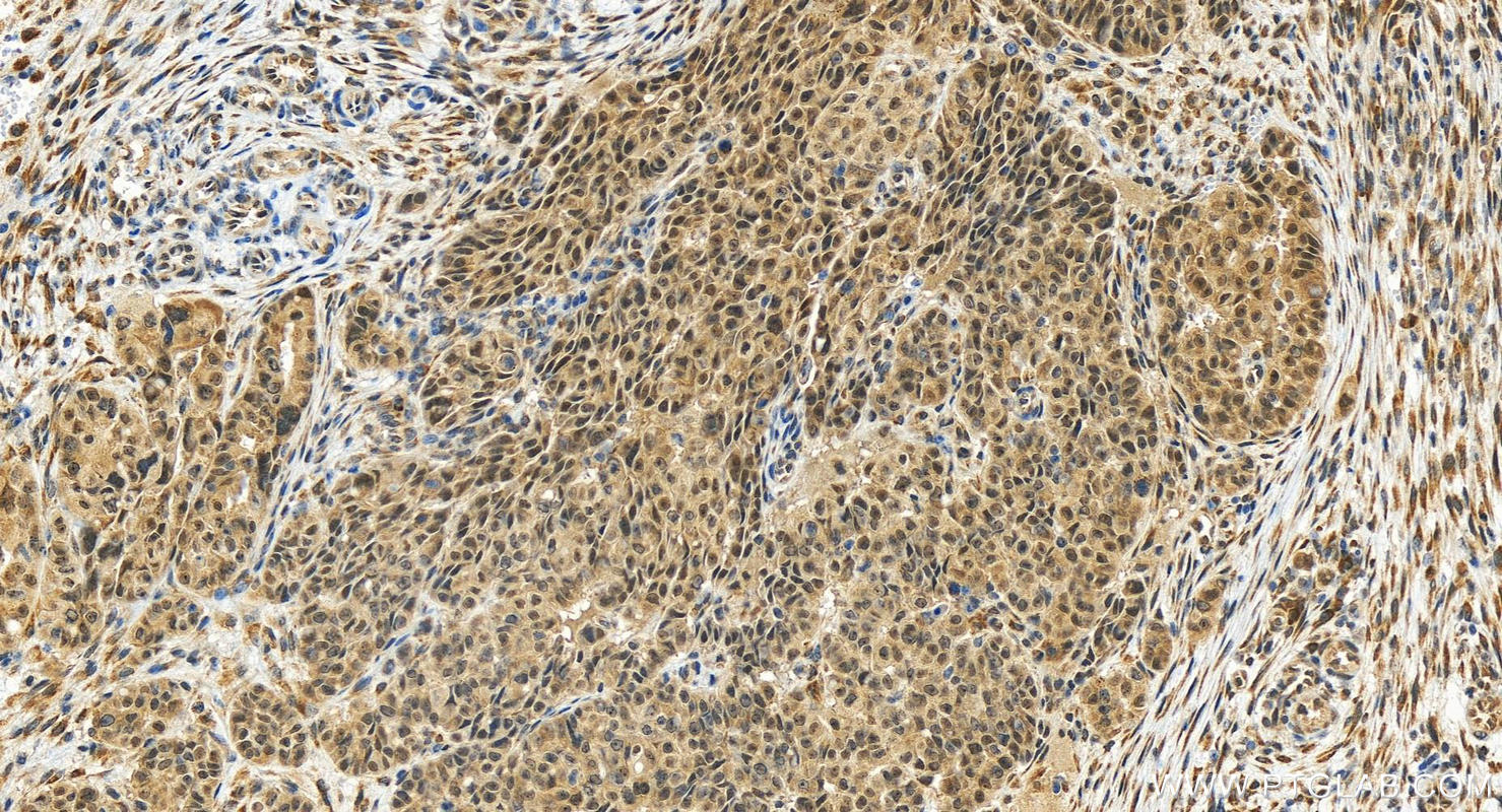 IHC staining of human ovarian  cancer using 16698-1-AP