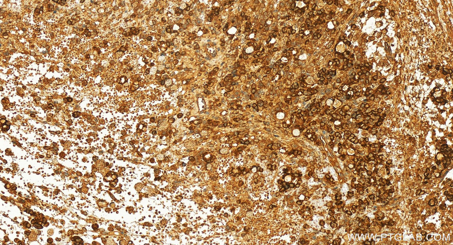 IHC staining of human ovary cancer using 16120-1-AP