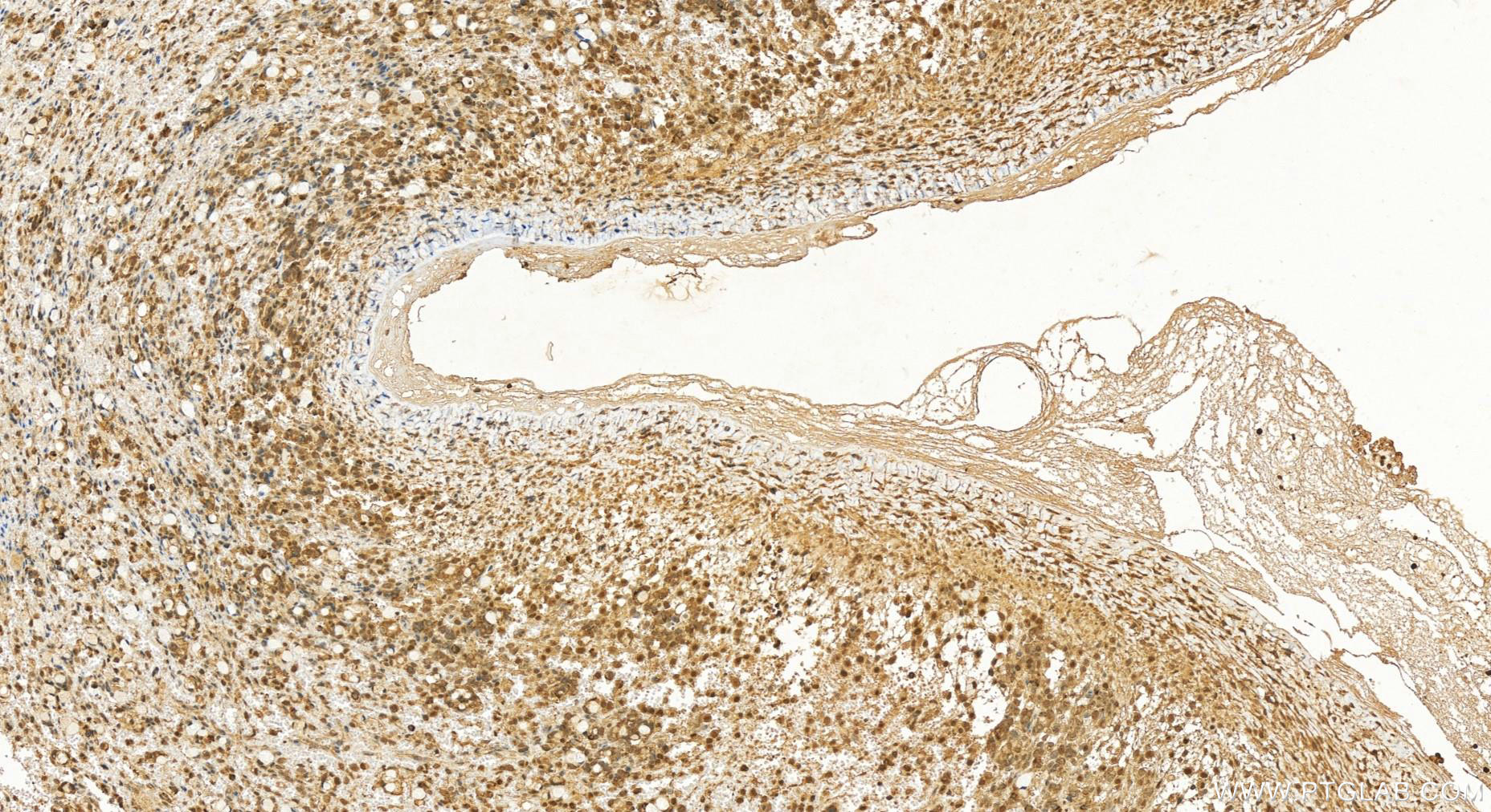 IHC staining of human ovary cancer using 15807-1-AP