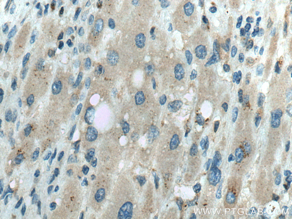 IHC staining of human liver cancer using 26150-1-AP