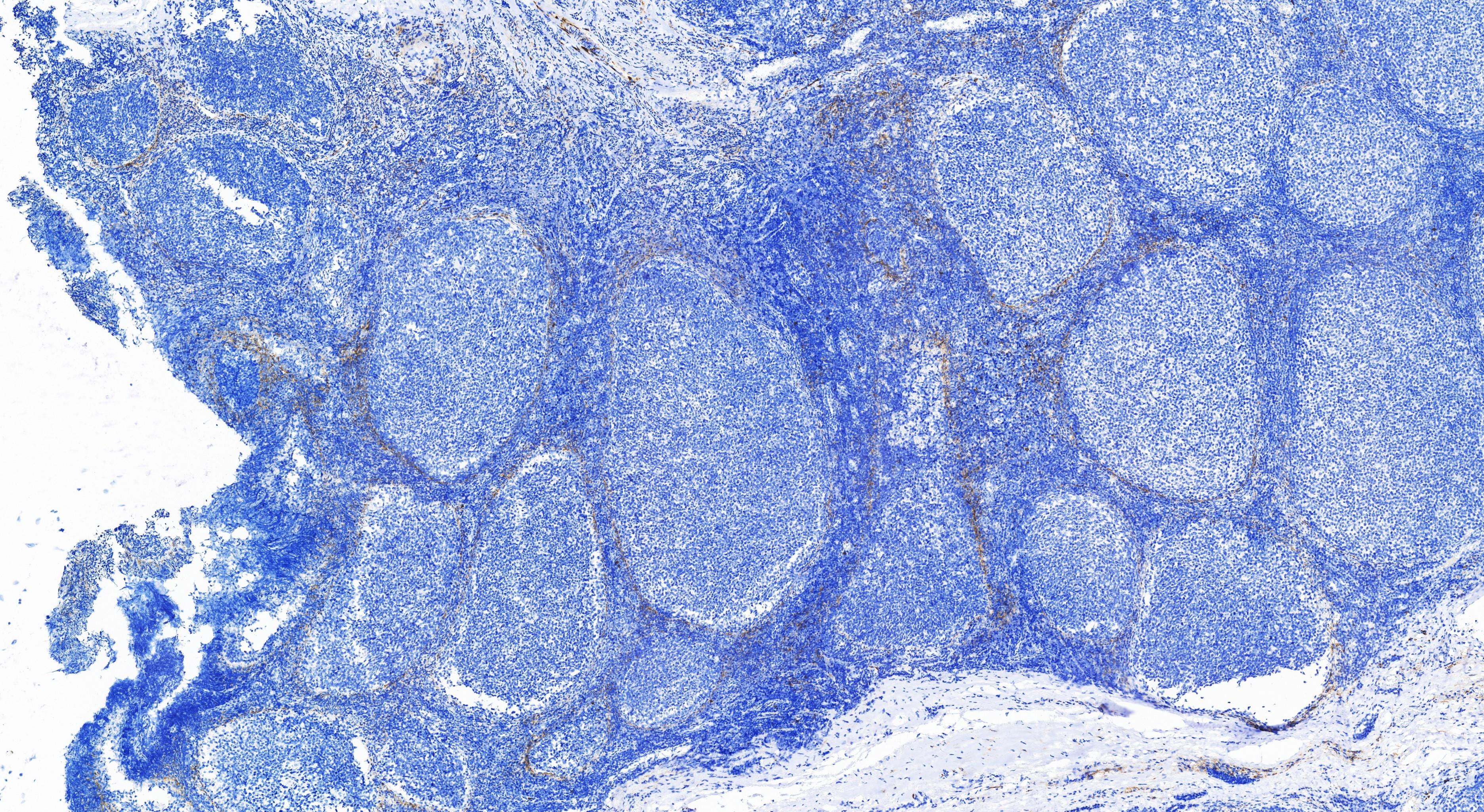 IHC staining of human tonsillitis using 82715-3-RR (same clone as 82715-3-PBS)