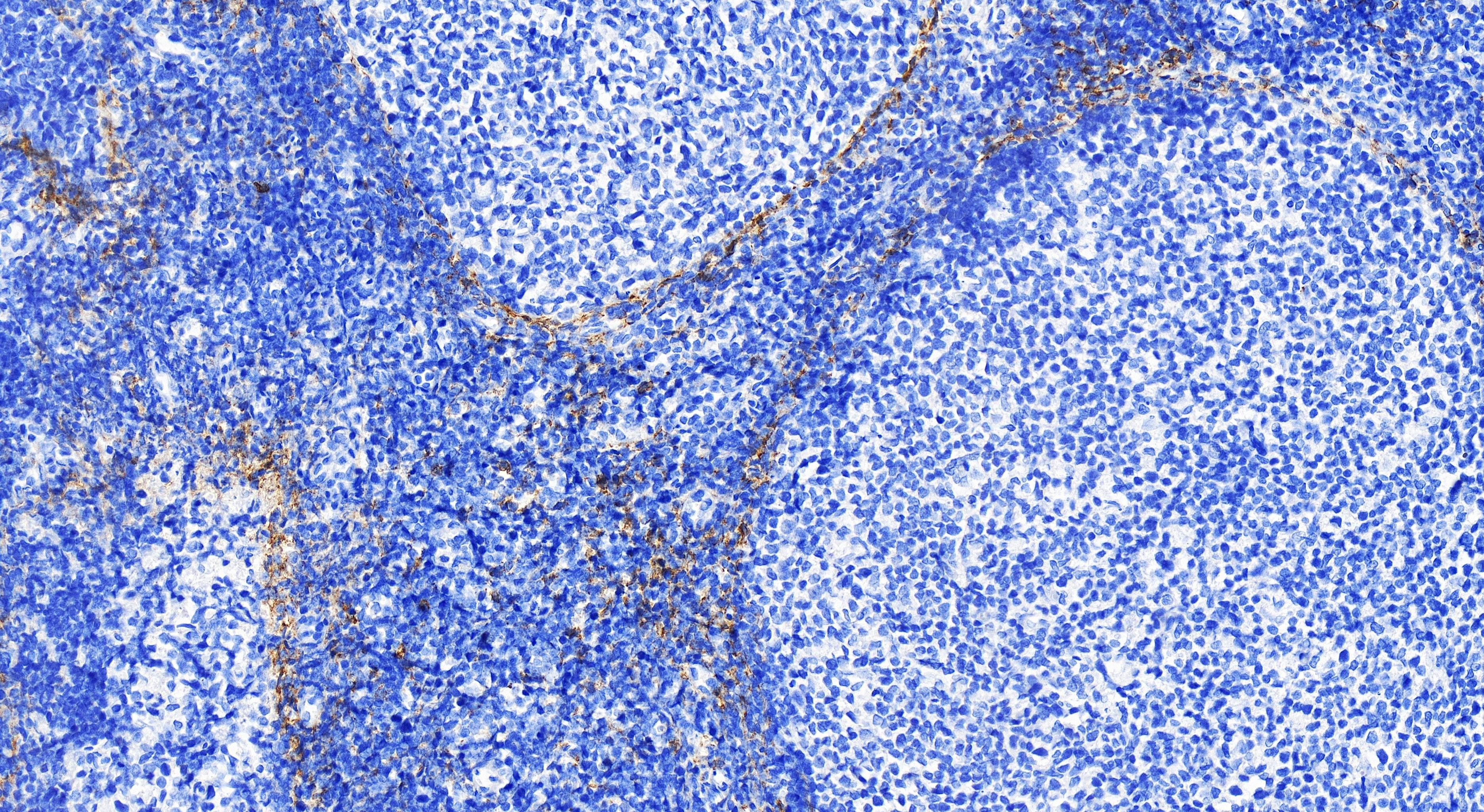 IHC staining of human tonsillitis using 82715-3-RR (same clone as 82715-3-PBS)