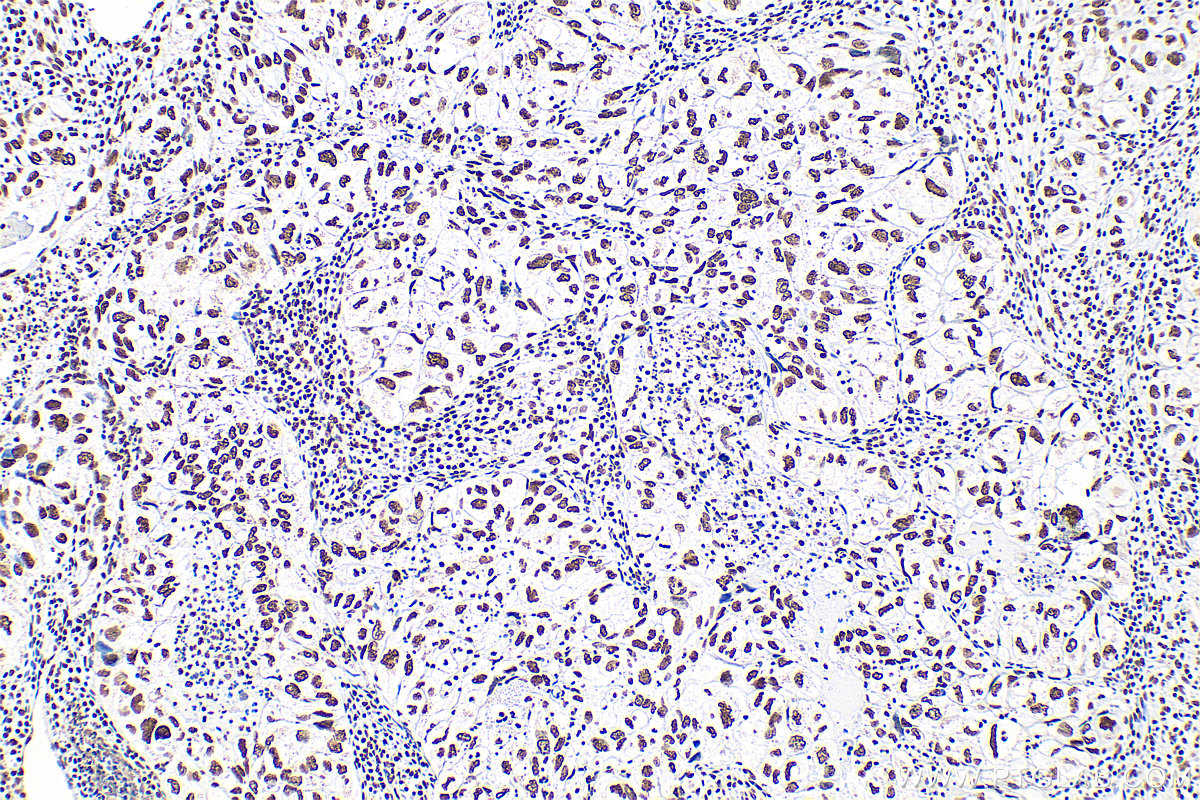 IHC staining of human lung cancer using 83380-1-RR