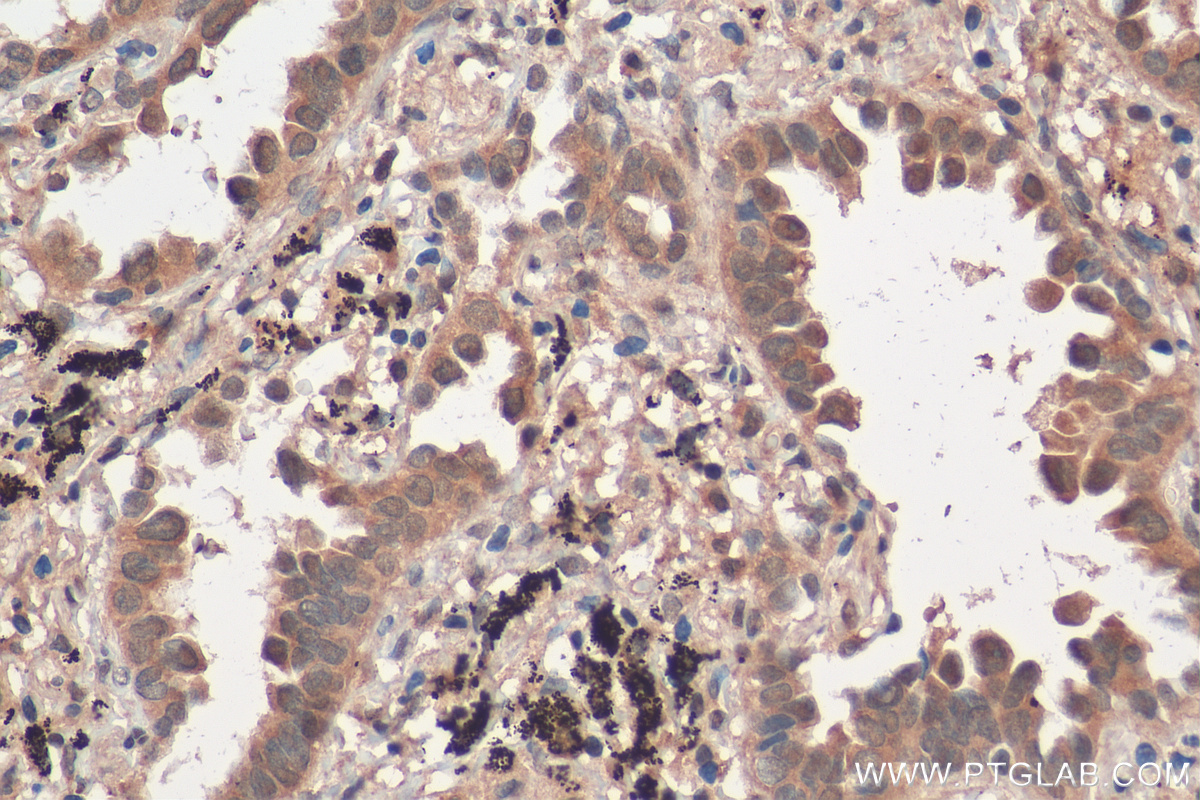 IHC staining of human lung cancer using 29587-1-AP