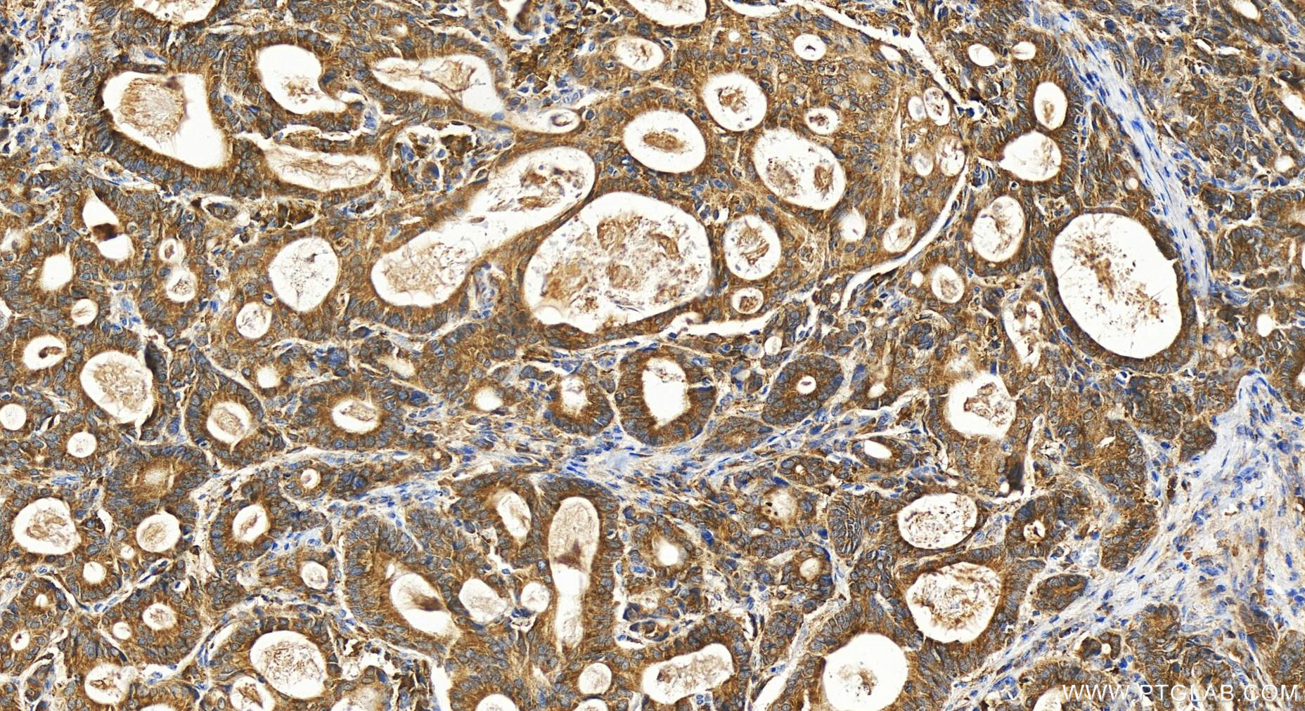 IHC staining of human stomach cancer using 19704-1-AP