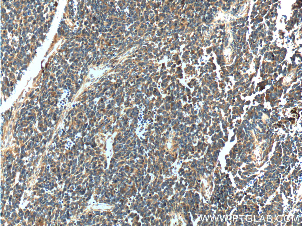 IHC staining of human medulloblastoma using 12184-1-AP