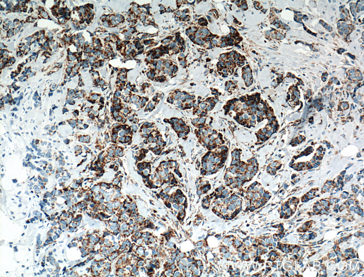 IHC staining of human breast cancer using 66050-1-Ig (same clone as 66050-1-PBS)
