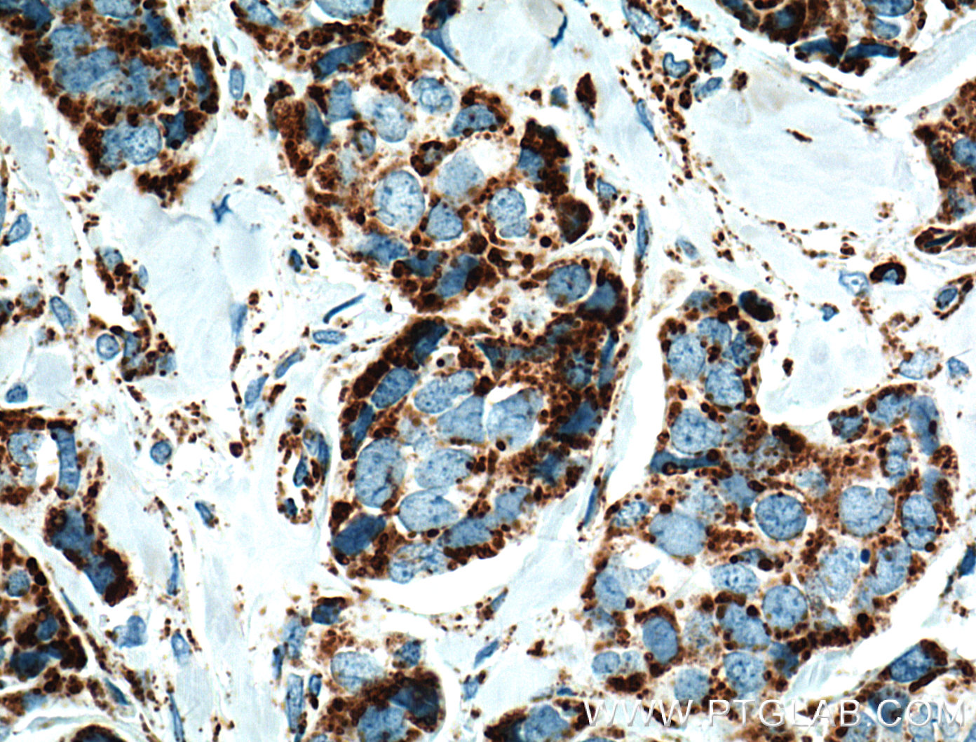 IHC staining of human breast cancer using 66050-1-Ig (same clone as 66050-1-PBS)