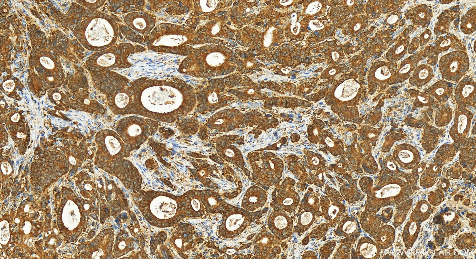 IHC staining of human stomach cancer using 15064-1-AP