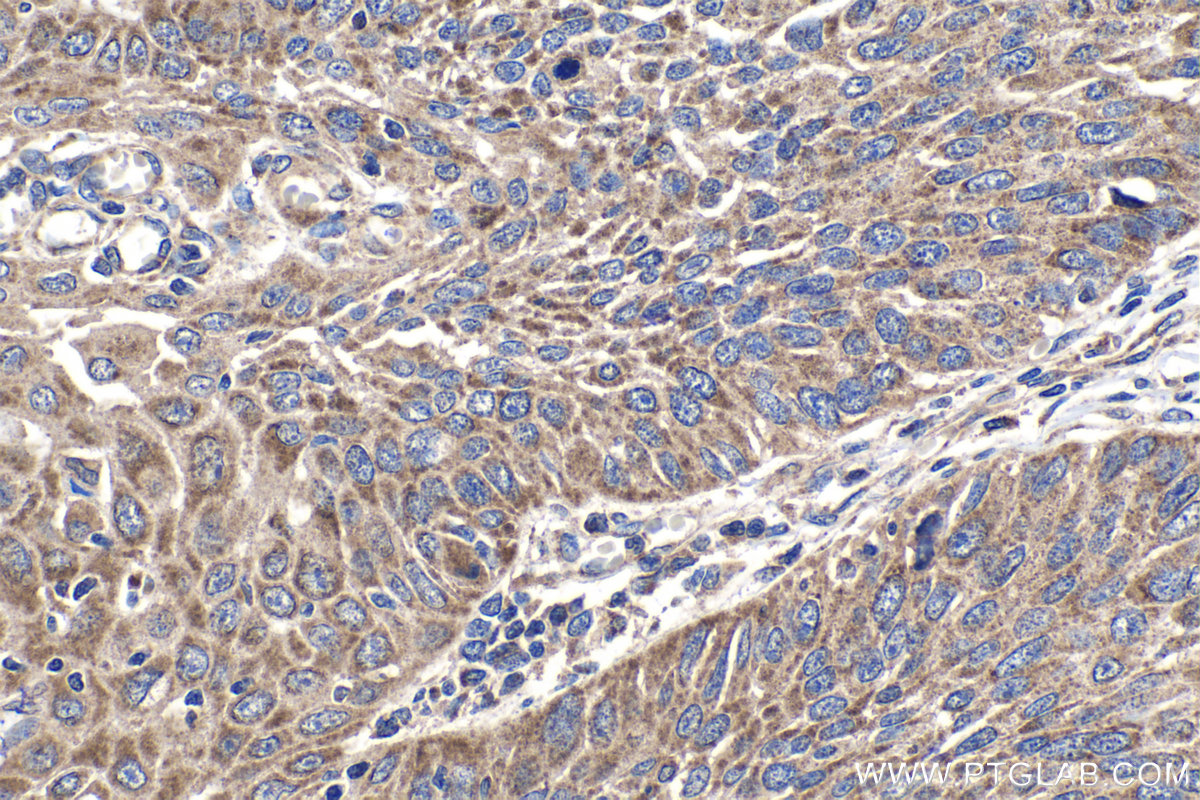 IHC staining of human oesophagus cancer using 15181-1-AP