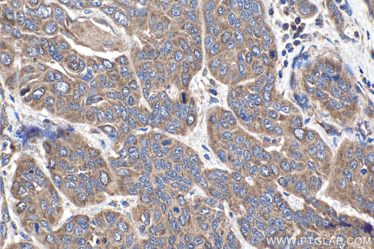 IHC staining of human oesophagus cancer using 15181-1-AP