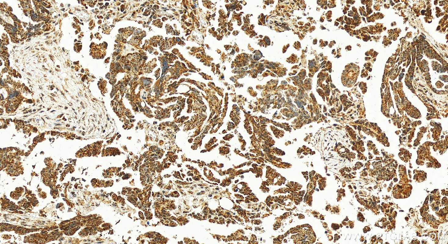 IHC staining of human ovary cancer using 15589-1-AP