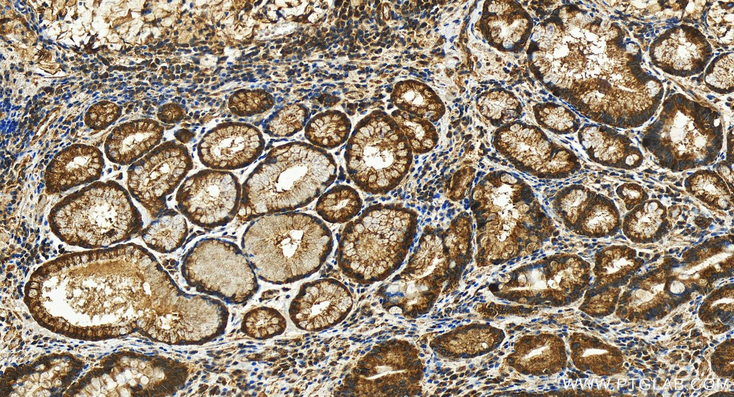 IHC staining of human stomach cancer using 27931-1-AP