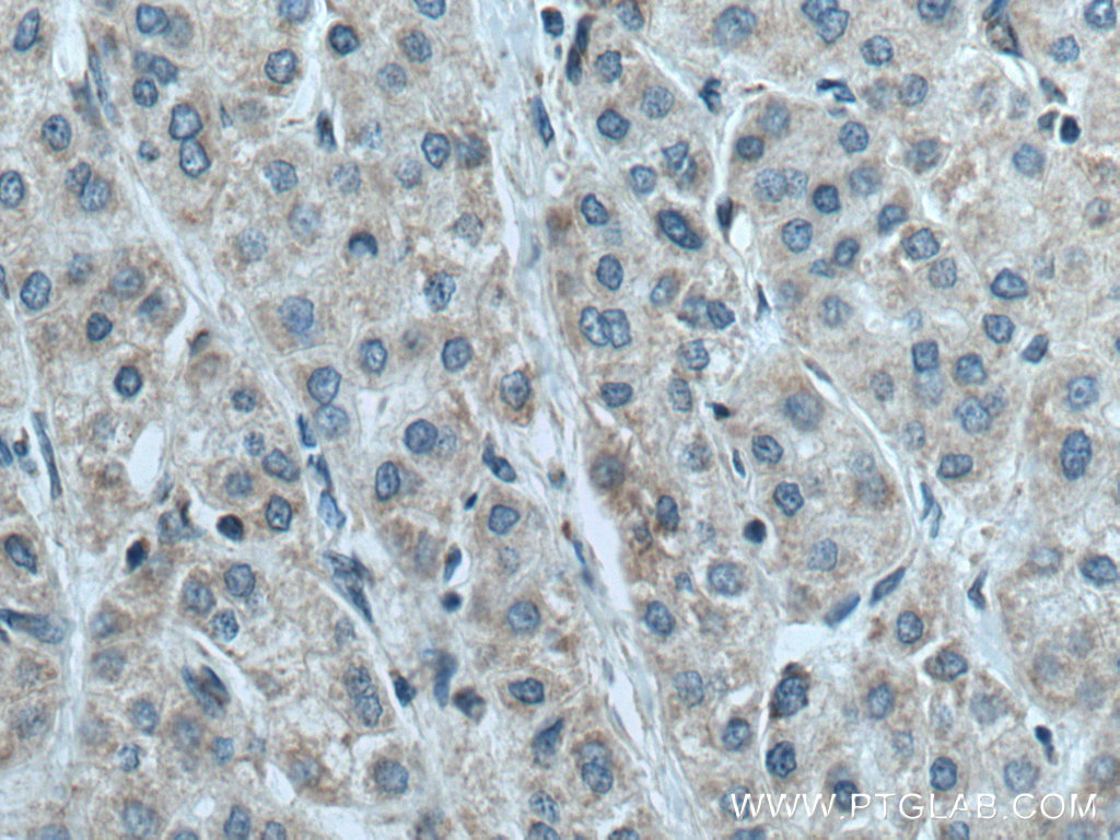 IHC staining of human liver cancer using 16037-1-AP