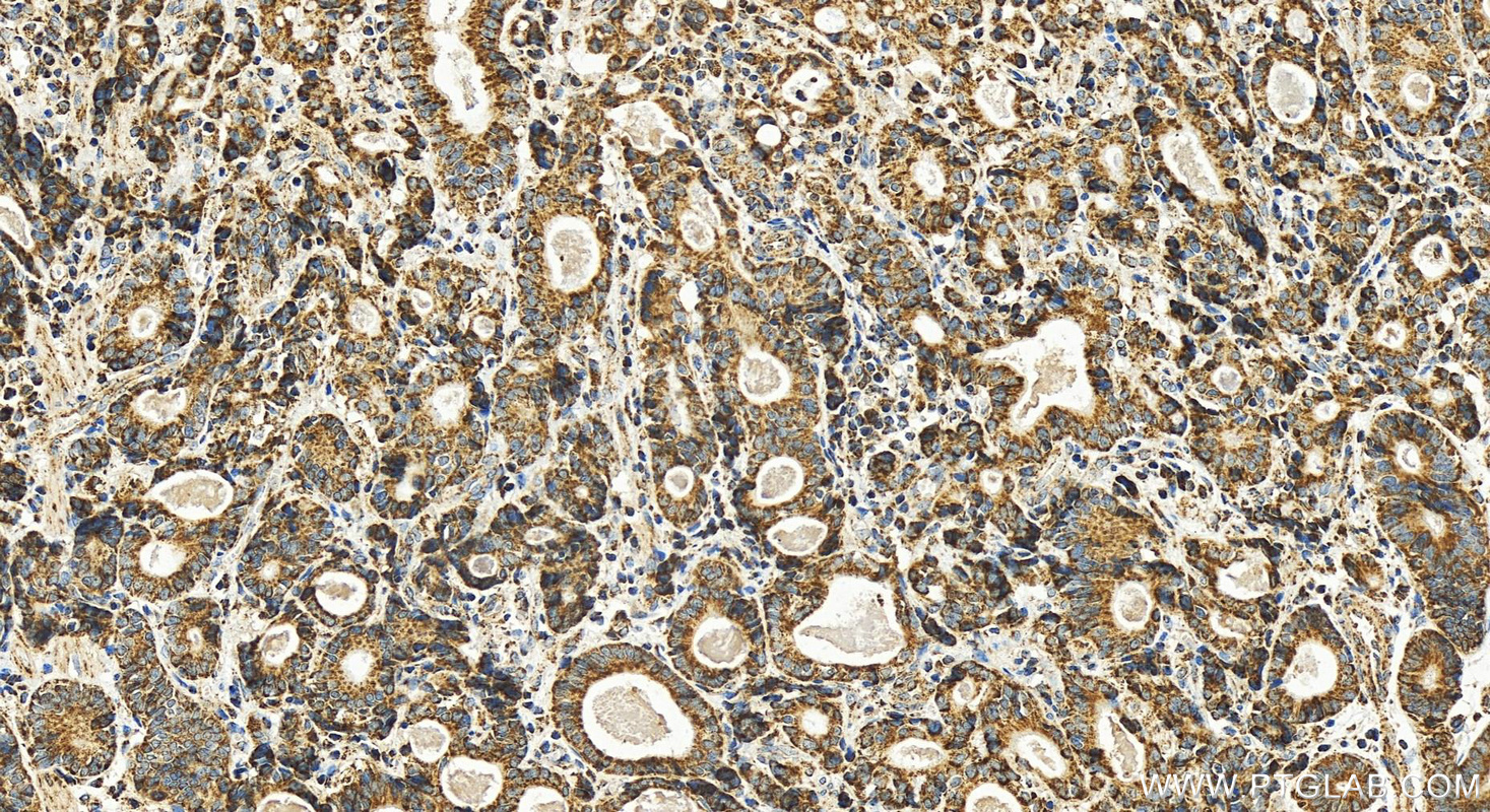 IHC staining of human stomach cancer using 83216-3-RR