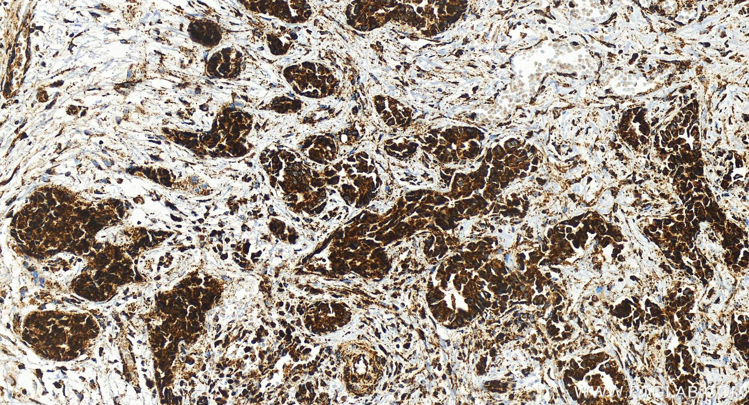 IHC staining of human intrahepatic cholangiocarcinoma using 83216-3-RR