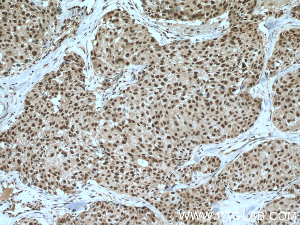 IHC staining of human lung cancer using 27146-1-AP