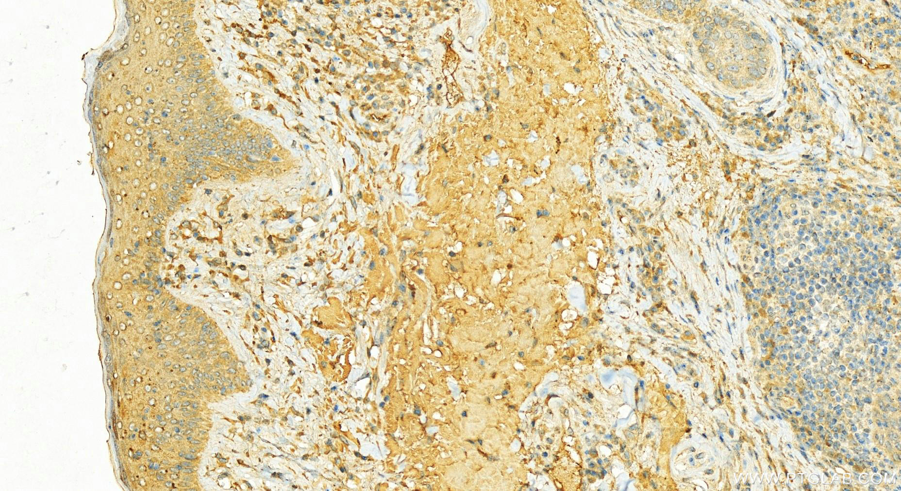 IHC staining of human skin cancer using 14233-1-AP (same clone as 14233-1-PBS)