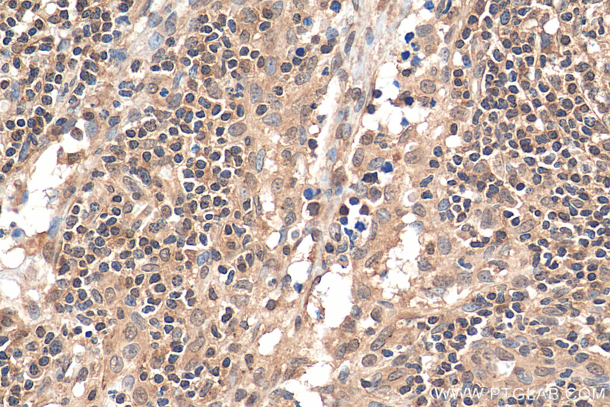 IHC staining of human lymphoma using 11192-1-AP (same clone as 11192-1-PBS)