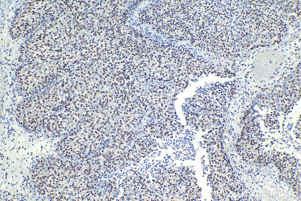 IHC staining of human urothelial carcinoma using 16418-1-AP