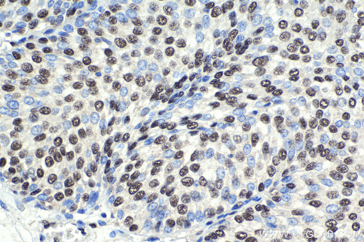 IHC staining of human urothelial carcinoma using 16418-1-AP