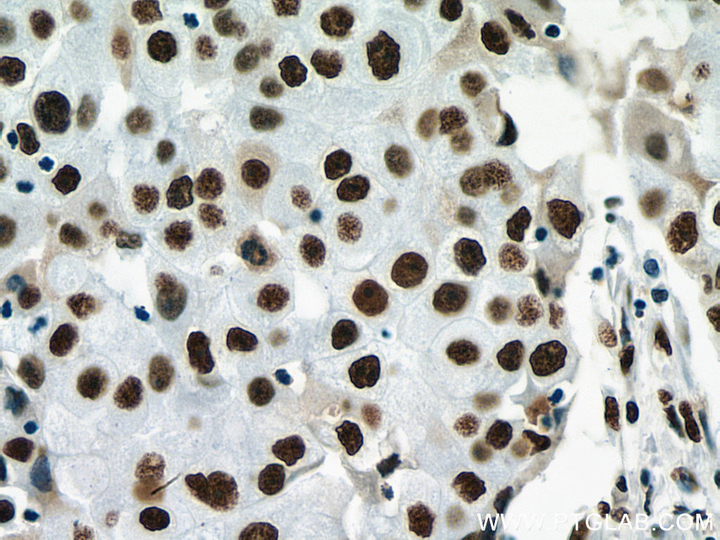 IHC staining of human breast cancer using 67685-1-Ig (same clone as 67685-1-PBS)