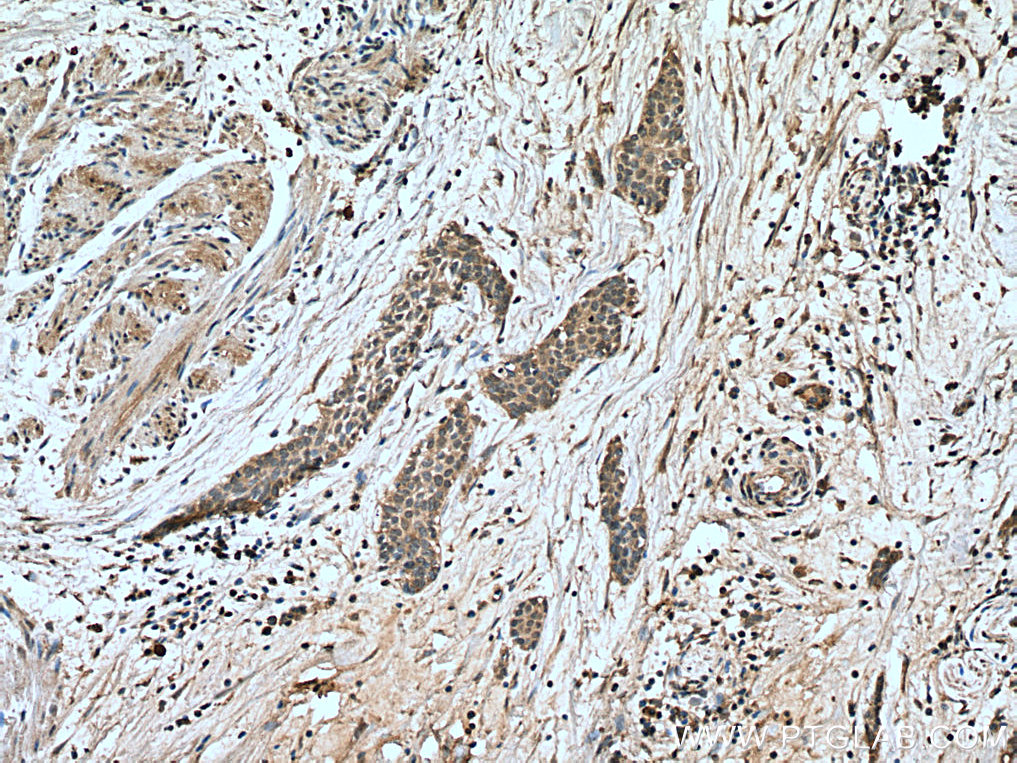 IHC staining of human urothelial carcinoma using 66963-1-Ig (same clone as 66963-1-PBS)