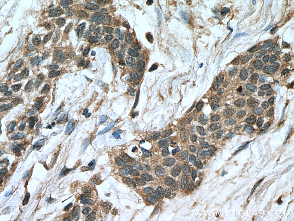 IHC staining of human urothelial carcinoma using 66963-1-Ig (same clone as 66963-1-PBS)