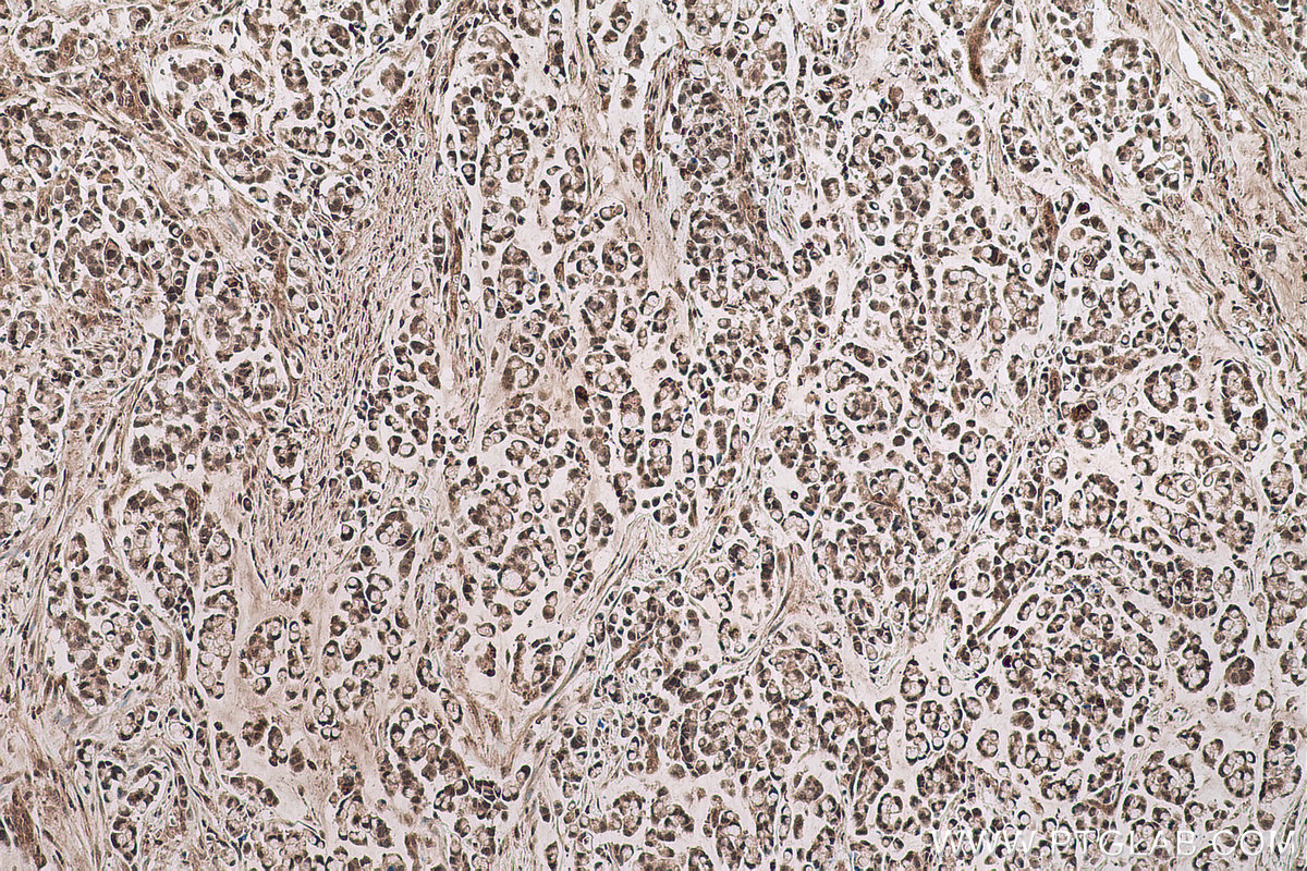 IHC staining of human colon cancer using 66992-1-Ig