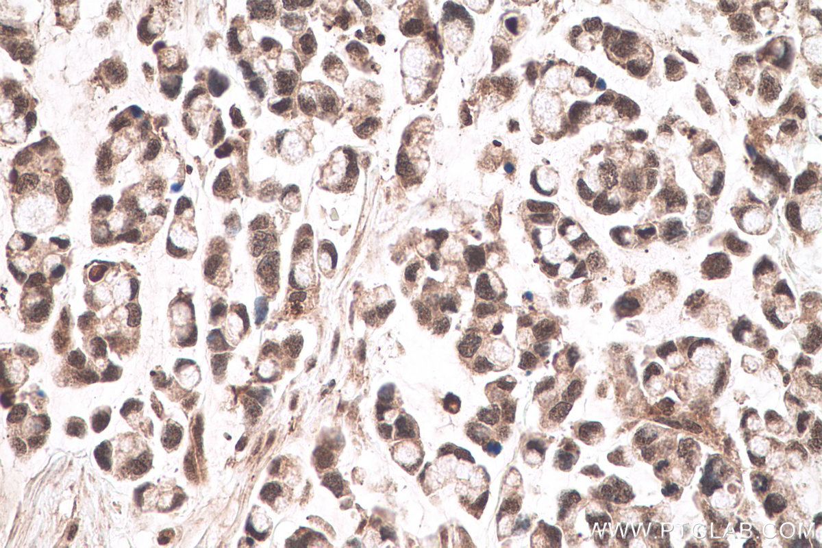 IHC staining of human colon cancer using 66992-1-Ig