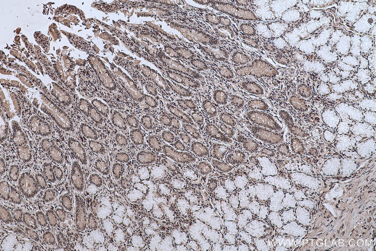 IHC staining of human stomach cancer using 66992-1-Ig