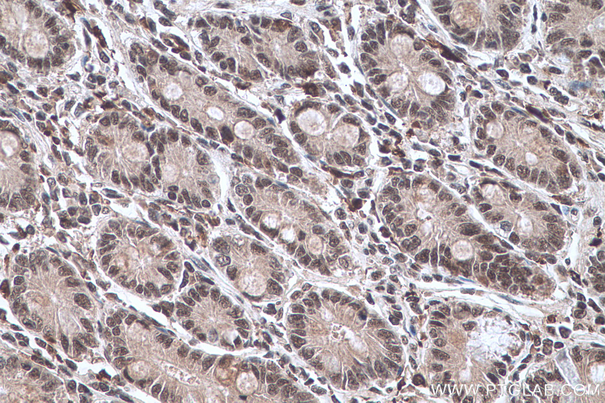 IHC staining of human stomach cancer using 66992-1-Ig