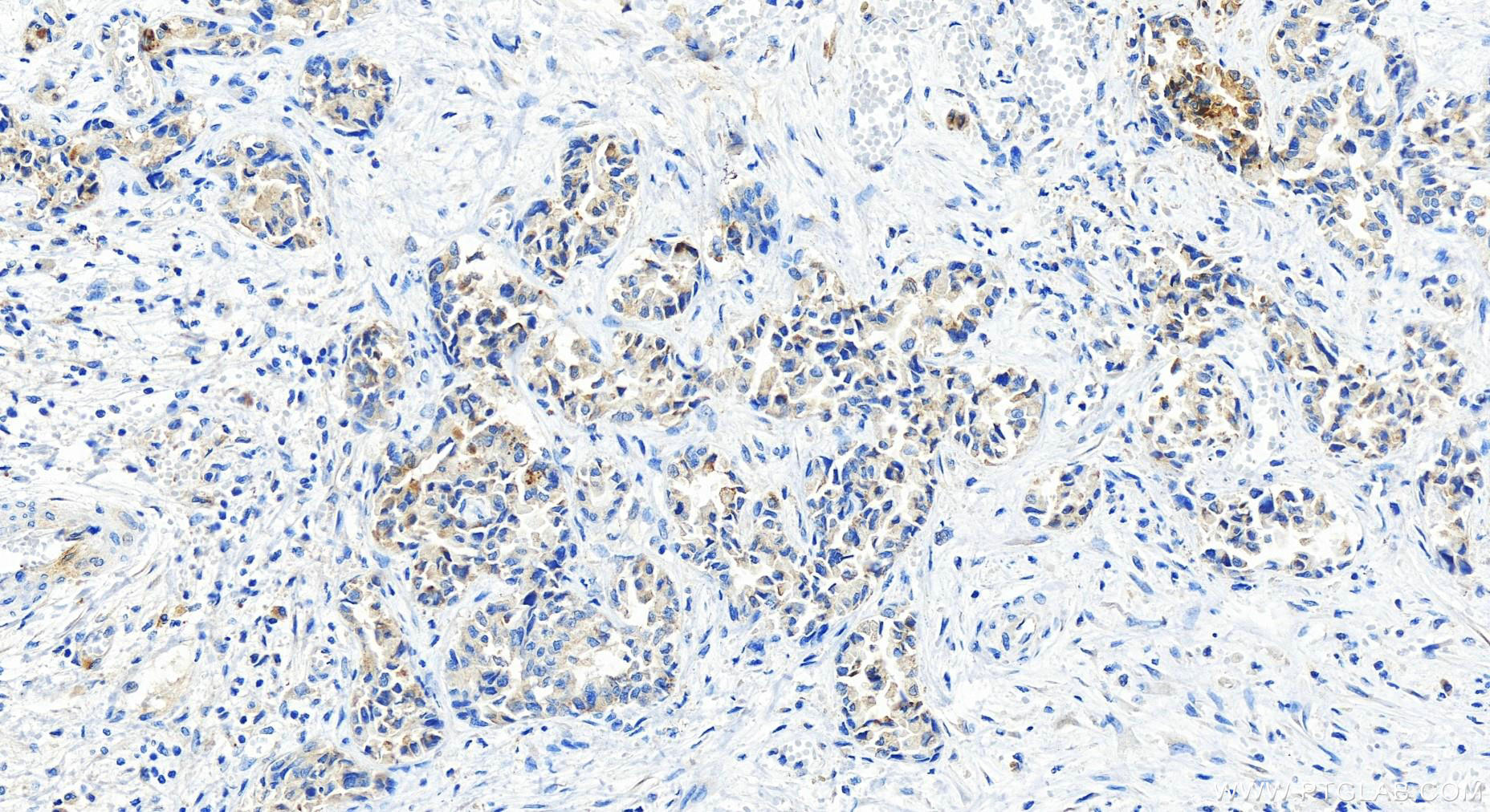 IHC staining of human intrahepatic cholangiocarcinoma using 82841-1-RR